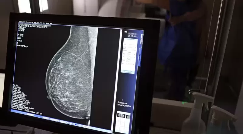 IA pode identificar risco de doenças cardíacas graves a partir de mamografias; entenda